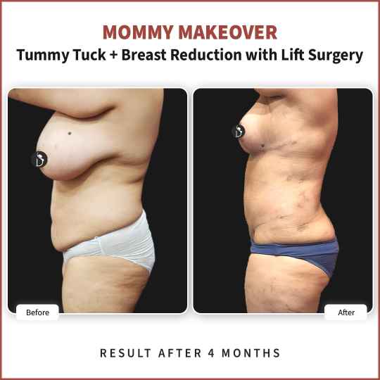 mommy makeover before and after