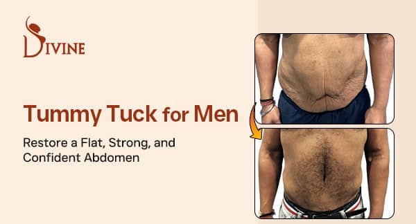 Tummy Tuck for Men