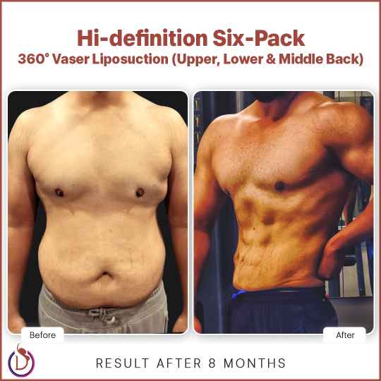 gynecomastia surgery gone wrong persistent chest bulges before after revision gynecomastia liposuction