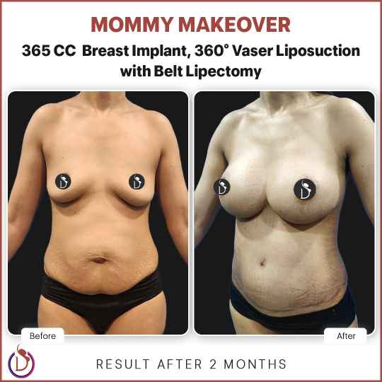 Mommy makeover in Delhi