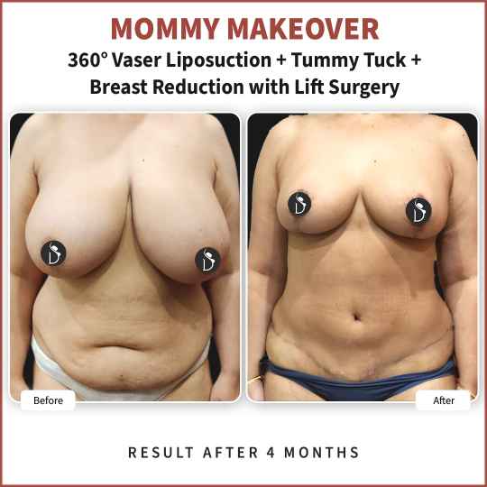 mommy makeover result in India