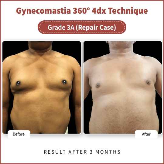 gynecomastia surgery gone wrong side chest fat bulges before after revision gynecomastia chest contouring