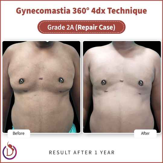 revision gynecomastia surgery before after chest fat removal and full chest contour correction