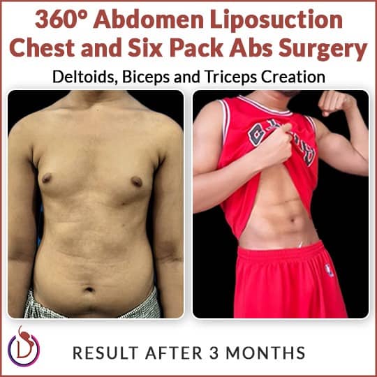 photo six pack ab surgery