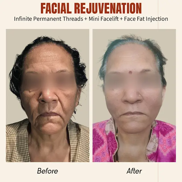 Best Treatment to Fix Face Sagging