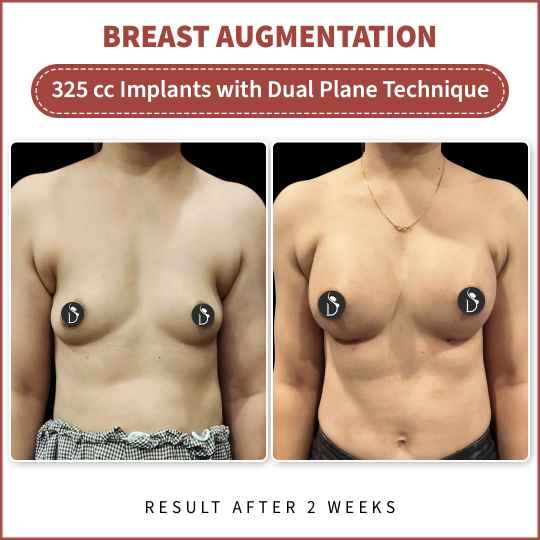 Breast Implant with Dual plane technique