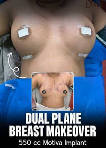 ual plane breast augmentation before and after