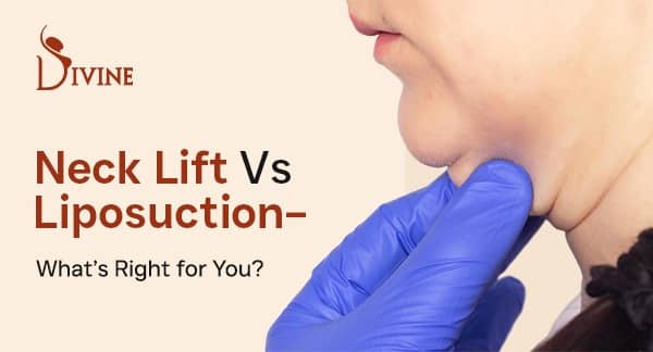 Neck Fat Removal in Delhi - Neck Lift vs Neck Liposuction