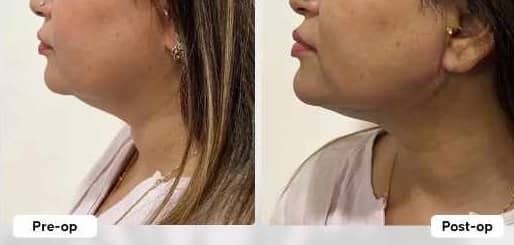 Neck lift with thread