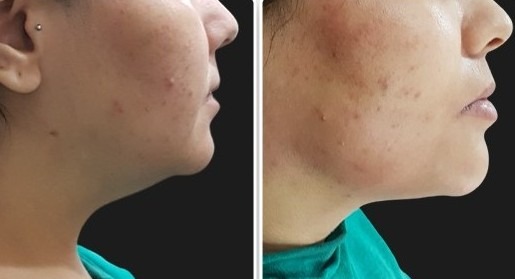 Neck liposuction Result
