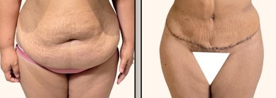 Extended tummy tuck scar