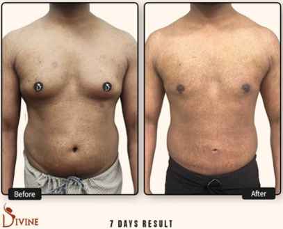 Faqs Gynecomastia
