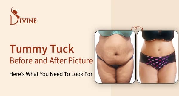 Tummy Tuck Before and After Picture