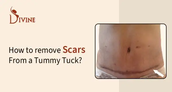 Tummy Tuck Scar Removal