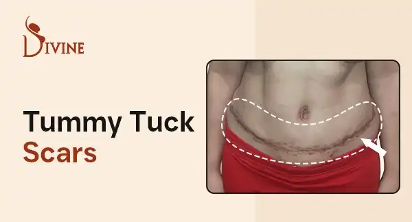 Tummy Tuck Scars -Types, Healing & Results Guide