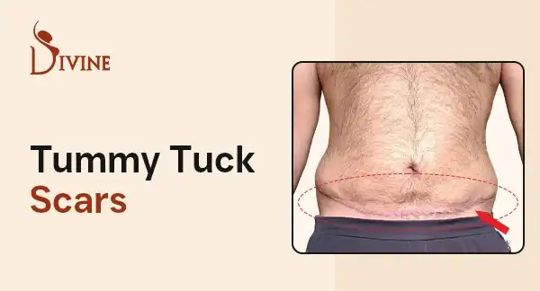 Tummy Tuck Scars: Types, Healing & Results Guide