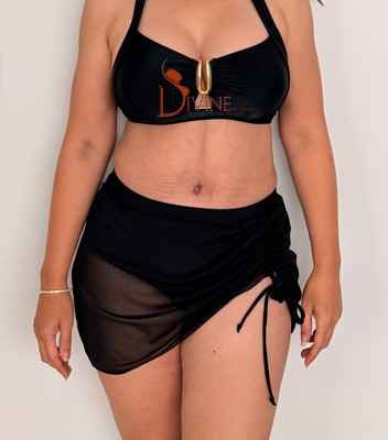 Tummy tuck after picture