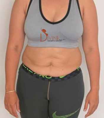 Tummy tuck before picture