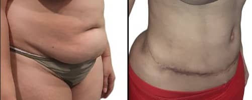 Types of Tummy Tuck Scars