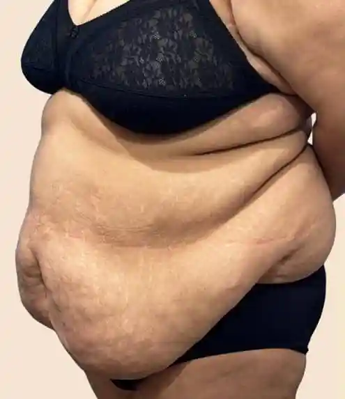 Why Do Patients Need a Tummy Tuck