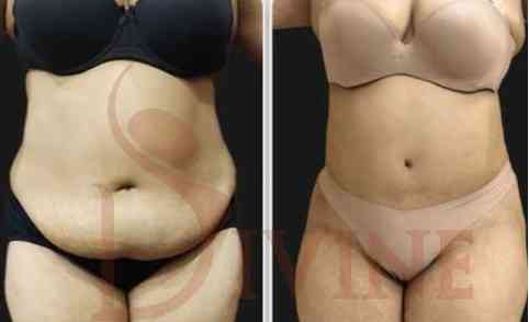 Why Tummy Tuck Before & After Pictures
