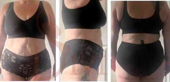Massive Weight Loss Treatment 