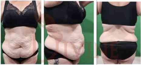 Massive Weight Loss Patient 