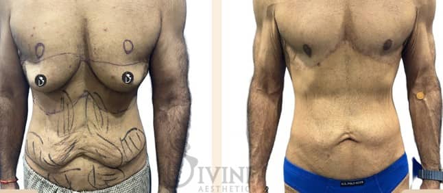 reverse tummy tuck image