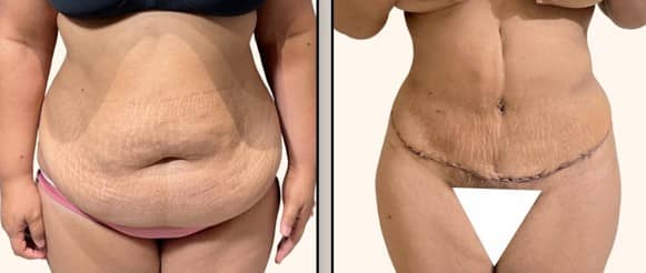 tummy tuck with liposuction result in delhi