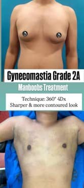 Gynecomastia Surgery in Kolkata