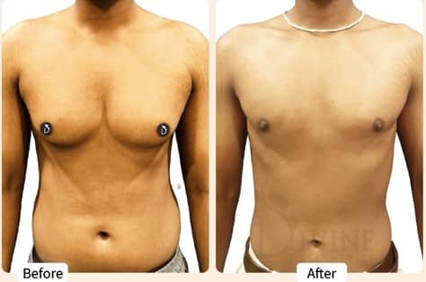gynecomastia surgery in Mumbai