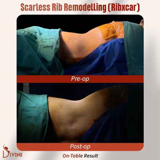 Rib remodeling befoe and after